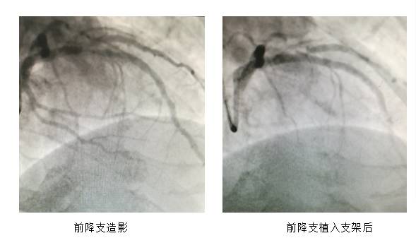 心血管疏通最新技术，开启生命新通道